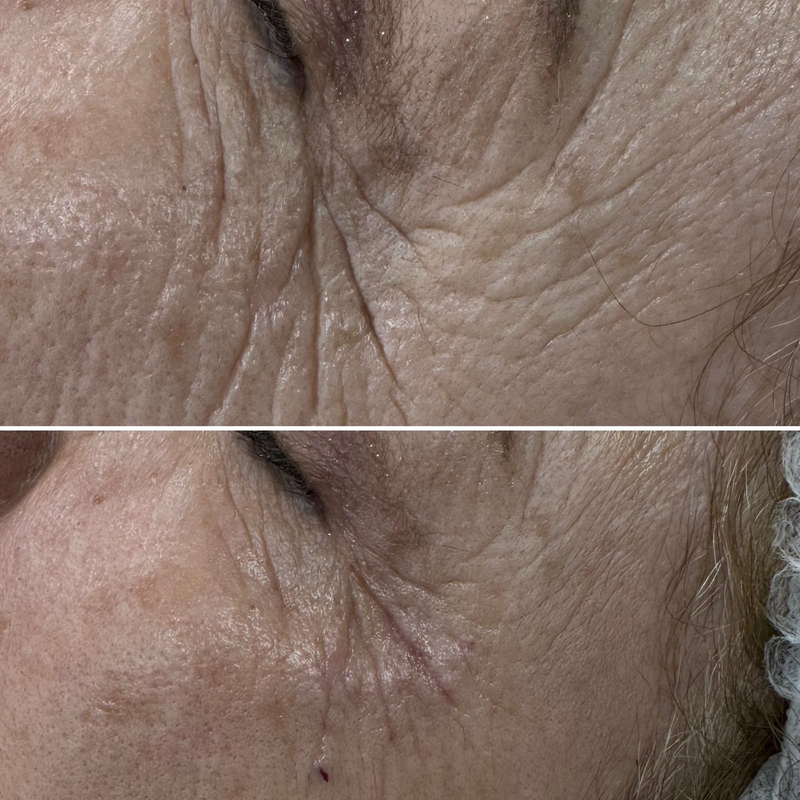 antes y despues CG STYLER ZONA PERIOCULAR